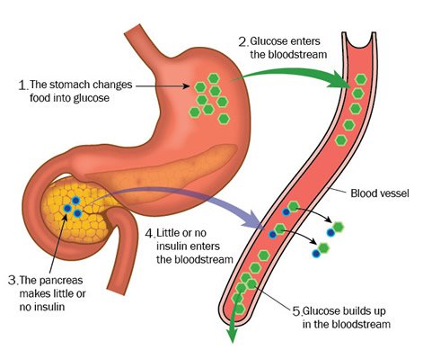 Insulin and the pancreas in the role of glucose metabolism, showing the effects of diabetes. (Blamb/Shutterstock)