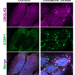 Depiction of temporary condensates under stress conditions. In magenta is one of our target proteins of interest, UBQLN2, and in green is a stress granule (condensate) marker. The bottom row is a merge containing blue for the nucl