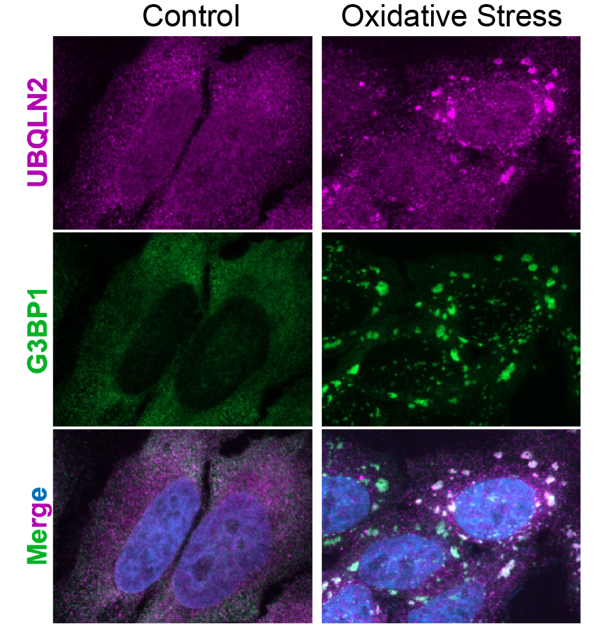 Depiction of temporary condensates under stress conditions. In magenta is one of our target proteins of interest, UBQLN2, and in green is a stress granule (condensate) marker. The bottom row is a merge containing blue for the nucl